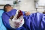 قطع مچ دست یک نفر در حادثه چهارشنبه سوری قم